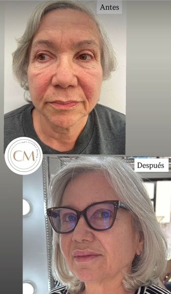 armonizacion facial