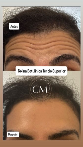 toxina botulinica